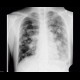 Lung metastases, canon ball: X-ray - Plain radiograph